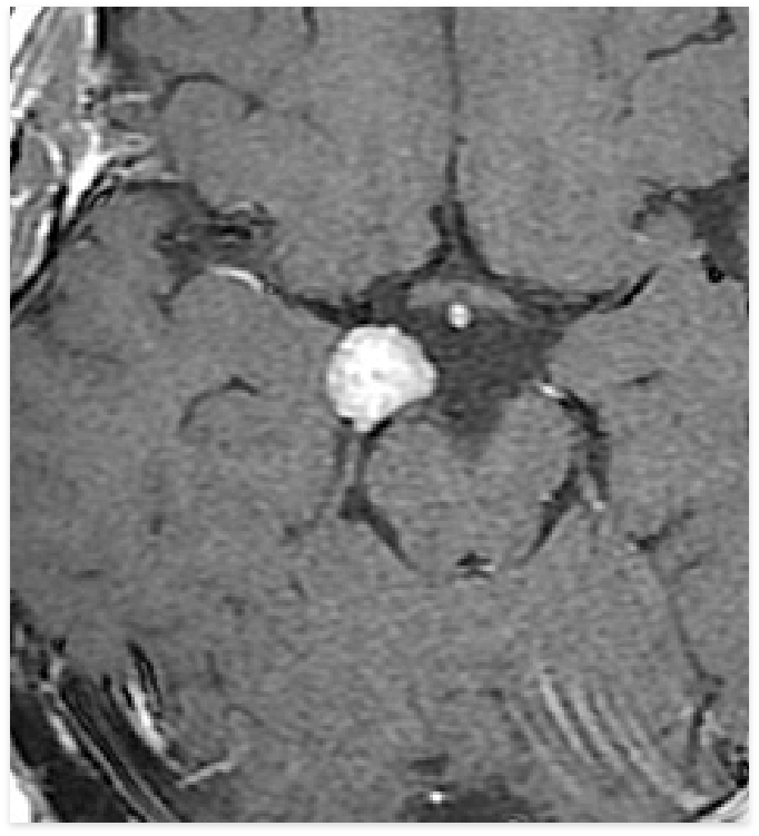 Meningioma