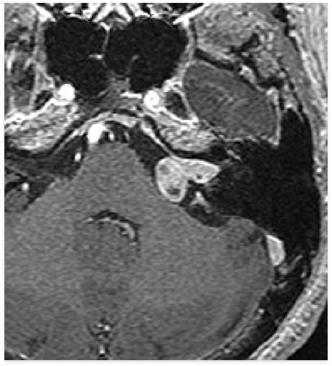 Vestibular Schwannoma