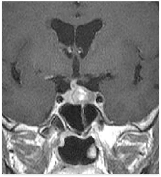 Pituitary Tumor