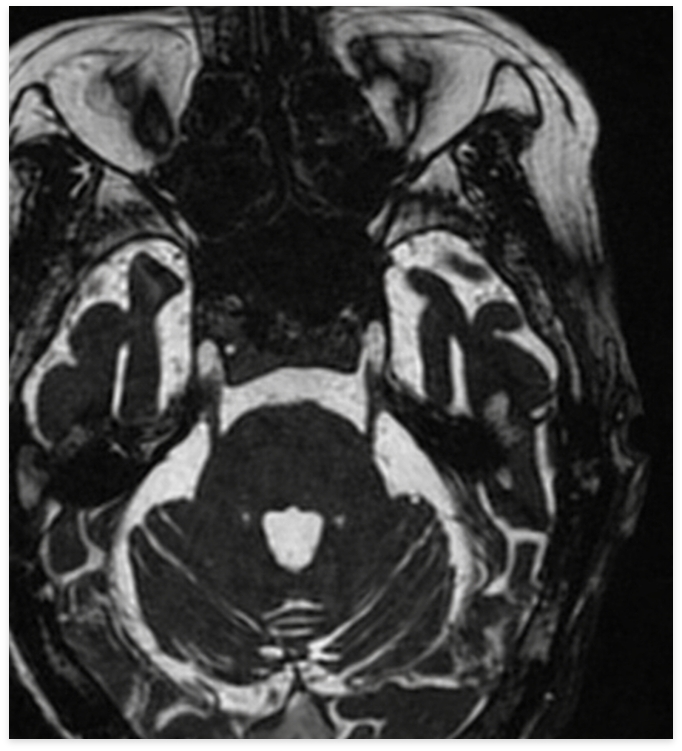 Trigeminal Neuralgia