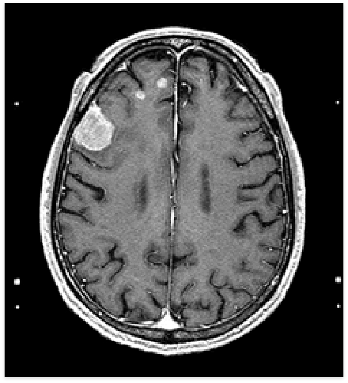 Other Benign Brain Tumors